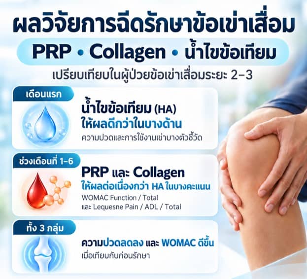 PRP, คอลลาเจน และน้ำไขข้อเทียม: งานวิจัยเปรียบเทียบการฉีดรักษาข้อเข่าเสื่อมบอกอะไรเรา?
